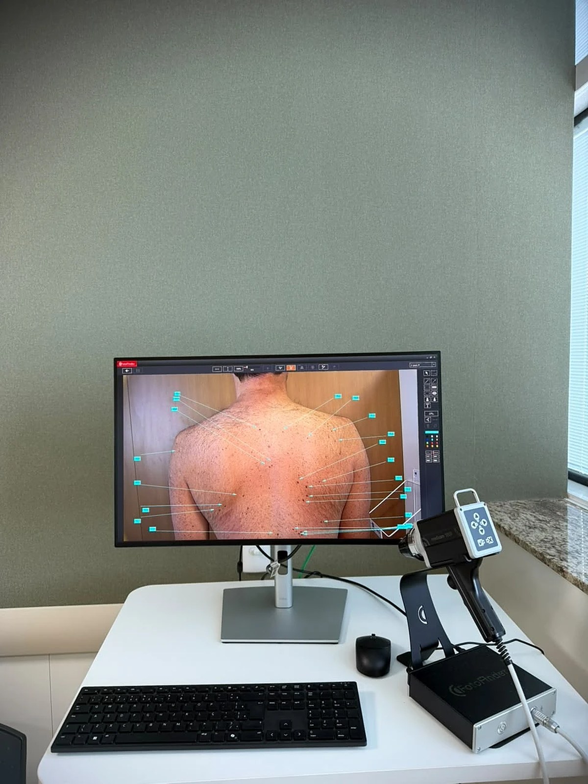 Equipamento FotoFinder de mapeamento corporal digital usado pelo Dr. Gerson Filipe Menezes em Belo Horizonte - MG